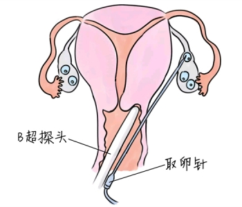 小儿退烧推拿手法 5种广州捐卵宝宝退烧按摩方法